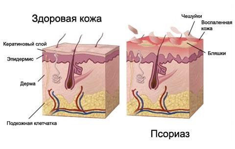 заболевание кожи