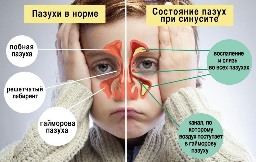 состояние пазух при синусите